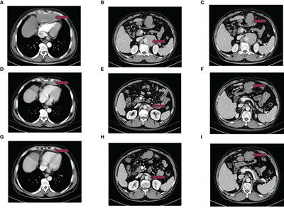 Frontiers Tislelizumab Immunotherapy Combined With Chemotherapy In